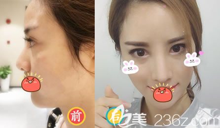 杭州薇琳隆鼻<span style= 杭州薇琳隆鼻<span style=