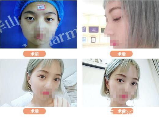 胡斌醫(yī)生眼綜合整形案例