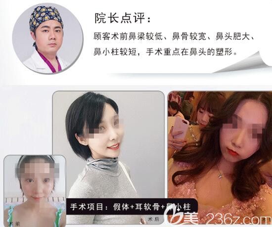 胡斌醫(yī)生鼻綜合整形案例