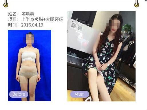 胡瑞芬醫(yī)生吸脂減肥案例