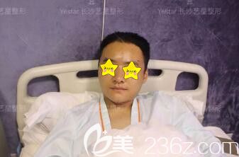 做自體脂肪填充面部術(shù)后第1天效果圖 做自體脂肪填充面部術(shù)后第1天效果圖