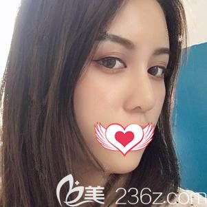 孫蘇寧醫(yī)生為我做自體脂肪填充面部術(shù)后28天擁有飽滿臉型 孫蘇寧醫(yī)生為我做自體脂肪填充面部術(shù)后28天擁有飽滿臉型