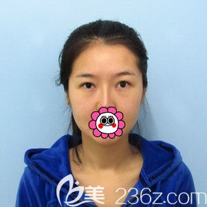 到哈爾濱索菲祛眼袋前照片 到哈爾濱索菲祛眼袋前照片