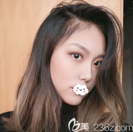 東莞維多利亞隆鼻案例一個(gè)月效果圖片 東莞維多利亞隆鼻案例一個(gè)月效果圖片
