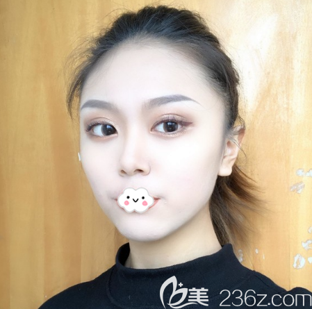 東莞小姐姐自述在東莞維多利亞找朱曉梅醫(yī)生做鼻綜合隆鼻的恢復全過程