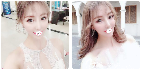 面診感覺(jué)廣州中家醫(yī)家庭醫(yī)生挺正規(guī)靠譜的就花一萬(wàn)多元找朱云做了韓國(guó)優(yōu)雅斯線(xiàn)雕埋線(xiàn)提升