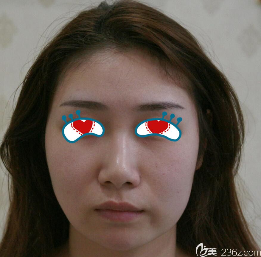 去蕪湖壹加壹做做埋線提升前正面照 去蕪湖壹加壹做做埋線提升前正面照