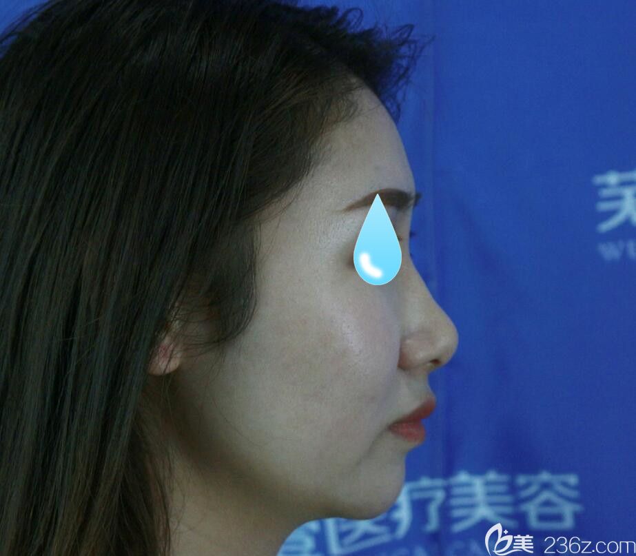 找壹加壹整形王心音做面部埋線提升前側面樣子 找壹加壹整形王心音做面部埋線提升前側面樣子