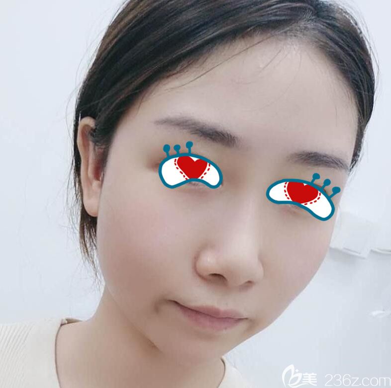 蕪湖壹加壹整形面部埋線提升術后第3天 蕪湖壹加壹整形面部埋線提升術后第3天