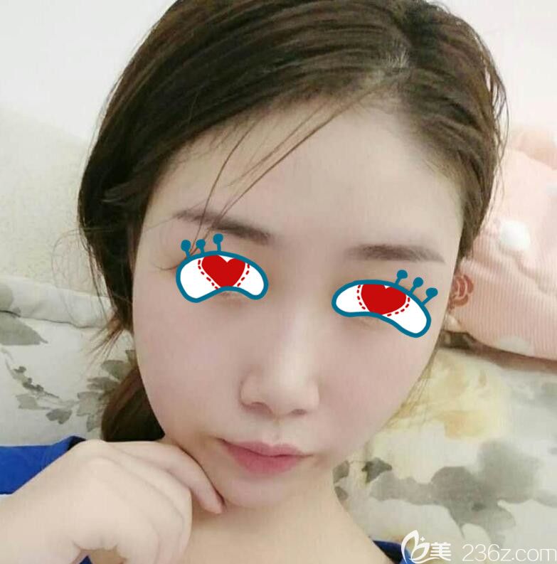 全臉埋線提升效果 全臉埋線提升效果