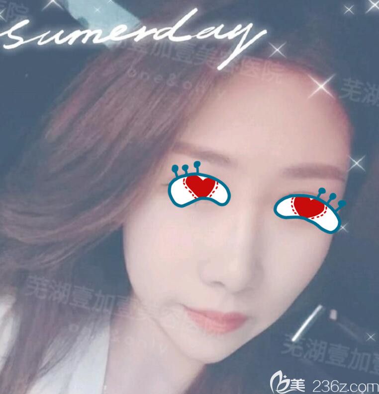 面部埋線提升術后25天 面部埋線提升術后25天