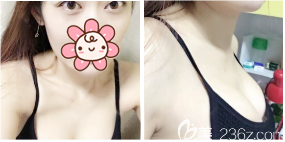 曼托假體隆胸術(shù)后20天拆線效果 曼托假體隆胸術(shù)后20天拆線效果