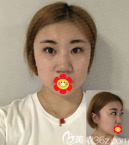 在紹興維美醫(yī)院做耳軟骨隆鼻前 在紹興維美醫(yī)院做耳軟骨隆鼻前