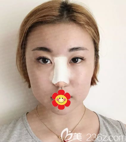 剛做完假體和耳軟骨隆鼻圖片 剛做完假體和耳軟骨隆鼻圖片