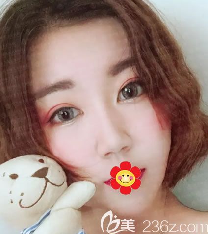 紹興維美隆鼻案例15天效果圖 紹興維美隆鼻案例15天效果圖