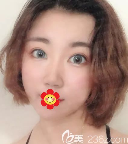 紹興做鼻子哪個(gè)醫(yī)院好,我選擇紹興維美康樂做了假體+耳軟骨綜合隆鼻,成功擺脫“扁塌鼻”