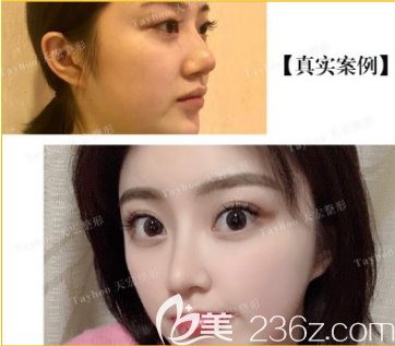 距離我在醫(yī)療美容門診部做全切雙眼皮已經(jīng)過去有半年的時間了，我來給大家看看照片