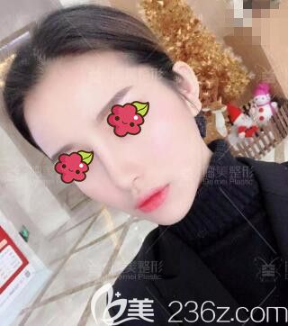 在邵陽(yáng)德美做肋軟骨復(fù)合隆鼻術(shù)后半個(gè)月效果 在邵陽(yáng)德美做肋軟骨復(fù)合隆鼻術(shù)后半個(gè)月效果