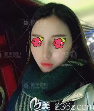 做完肋軟骨復(fù)合隆鼻術(shù)后2個(gè)月時(shí)的效果 做完肋軟骨復(fù)合隆鼻術(shù)后2個(gè)月時(shí)的效果