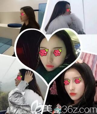 邵陽德美是正規(guī)醫(yī)院么？用我找李倩做的肋軟骨復(fù)合隆鼻術(shù)后3個(gè)月恢復(fù)效果圖告訴你！