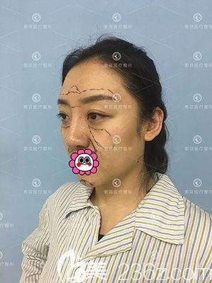 哈爾濱索菲做自體脂肪填充前設(shè)計畫線 哈爾濱索菲做自體脂肪填充前設(shè)計畫線