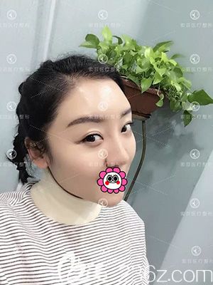 自體脂肪面部填充術(shù)后20天效果 自體脂肪面部填充術(shù)后20天效果