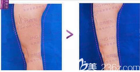 北京京韓腿部吸脂案例 北京京韓腿部吸脂案例