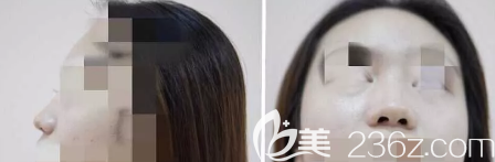 <!--<i data=20240703-sp></i>-->醫(yī)療美容門診部術(shù)前隆鼻側(cè)面和正面照片