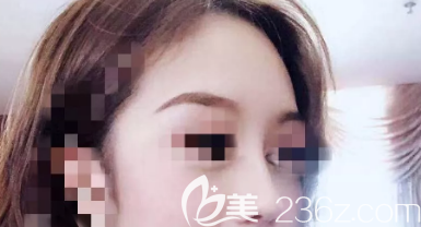 鼻綜合術(shù)后三個月側(cè)面照片