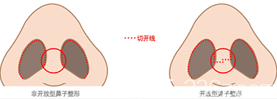 非開放型無痕隆鼻與開放型隆鼻對比圖