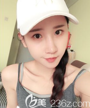 羅寧川自體脂肪全臉填充術(shù)后2個(gè)月 羅寧川自體脂肪全臉填充術(shù)后2個(gè)月