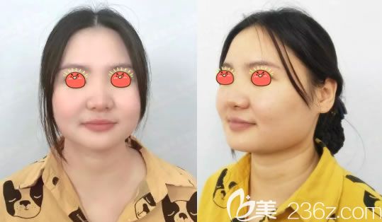 在嘉興禾美做隆鼻前的狀況 在嘉興禾美做隆鼻前的狀況