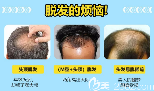 整形醫(yī)院各種脫發(fā)照片