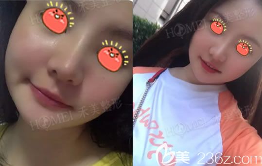 嘉興禾美隆鼻案例術(shù)后一周效果紀(jì)實(shí),一起見證我的新鼻子誕生過程吧