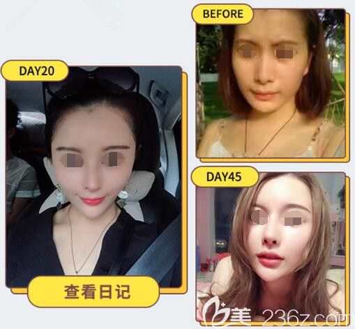 閨蜜到蘇州紫馨做的隆鼻案例 閨蜜到蘇州紫馨做的隆鼻案例