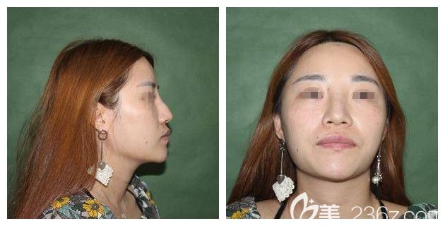 面診高羅鏞醫(yī)生術(shù)前鼻子塌塌的 面診高羅鏞醫(yī)生術(shù)前鼻子塌塌的