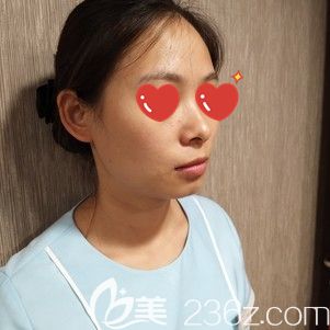 到武漢美基元做玻尿酸墊下巴術(shù)前的短下頦 到武漢美基元做玻尿酸墊下巴術(shù)前的短下頦