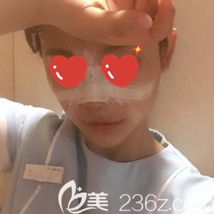 胡煜醫(yī)生幫我做玻尿酸墊下巴+鼻綜合術(shù)后即刻 胡煜醫(yī)生幫我做玻尿酸墊下巴+鼻綜合術(shù)后即刻