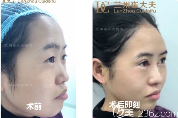 蘭州崔大夫整形全切雙眼皮+鼻綜合隆鼻前和術(shù)后即刻照片 蘭州崔大夫整形全切雙眼皮+鼻綜合隆鼻前和術(shù)后即刻照片