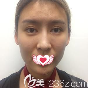 在石家莊天宏做線雕提升術(shù)前面部皮膚松弛下垂 在石家莊天宏做線雕提升術(shù)前面部皮膚松弛下垂