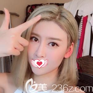 天宏整形醫(yī)生張學(xué)雷做埋線提升術(shù)后一周面部緊致飽滿 天宏整形醫(yī)生張學(xué)雷做埋線提升術(shù)后一周面部緊致飽滿