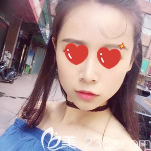 胡醫(yī)生做玻尿酸墊下巴術(shù)后65天下巴輪廓自然 胡醫(yī)生做玻尿酸墊下巴術(shù)后65天下巴輪廓自然