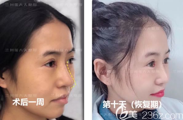 蘭州崔大夫徐隴豫切開雙眼皮第七天拆線后和第十天效果 蘭州崔大夫徐隴豫切開雙眼皮第七天拆線后和第十天效果