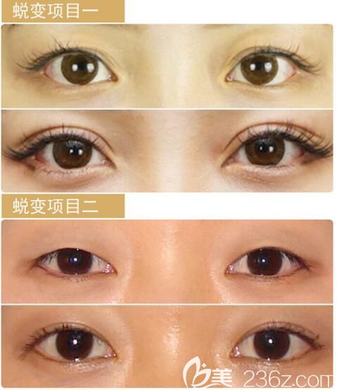 暑期到淮安哪家醫(yī)院整形變美?780元埋線雙眼皮580元吸脂的俏美整形價(jià)格表先來(lái)了解一下