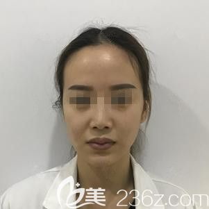 在石家莊天宏注射玻尿酸豐唇前唇部太厚 在石家莊天宏注射玻尿酸豐唇前唇部太厚