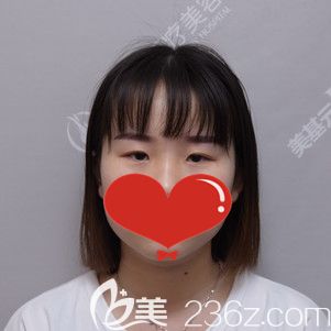 到武漢美基元做雙眼皮前眼睛無神的自己 到武漢美基元做雙眼皮前眼睛無神的自己