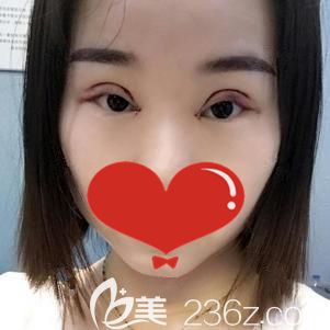 做切開雙眼皮術(shù)后7天到院進行拆線 做切開雙眼皮術(shù)后7天到院進行拆線