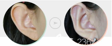 長春姬安娣對招風耳的整形前后效果圖 長春姬安娣對招風耳的整形前后效果圖