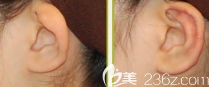 耳朵缺陷整形效果對比 耳朵缺陷整形效果對比
