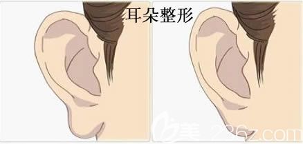 國內(nèi)耳朵整形哪家好 國內(nèi)耳朵整形哪家好